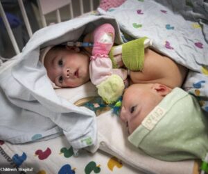 Mum’s Love As Separated Conjoined Daughters Come Home