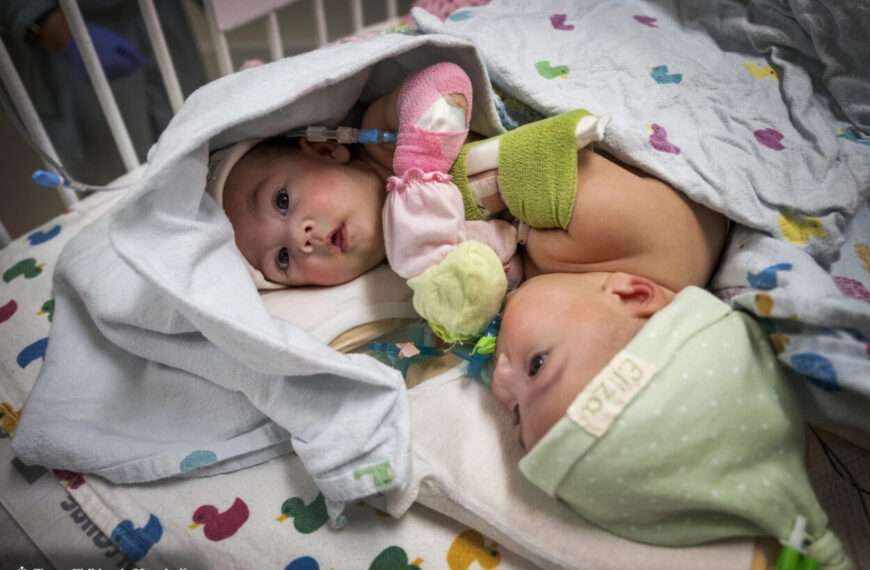 Mum’s Love As Separated Conjoined Daughters Come Home